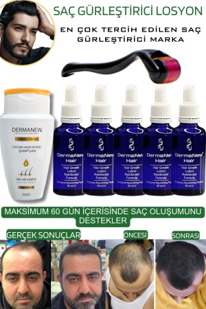 Hair Thickener Serum Roller Blue Shampoo Gift / /5x50ml - Dermanew Hair